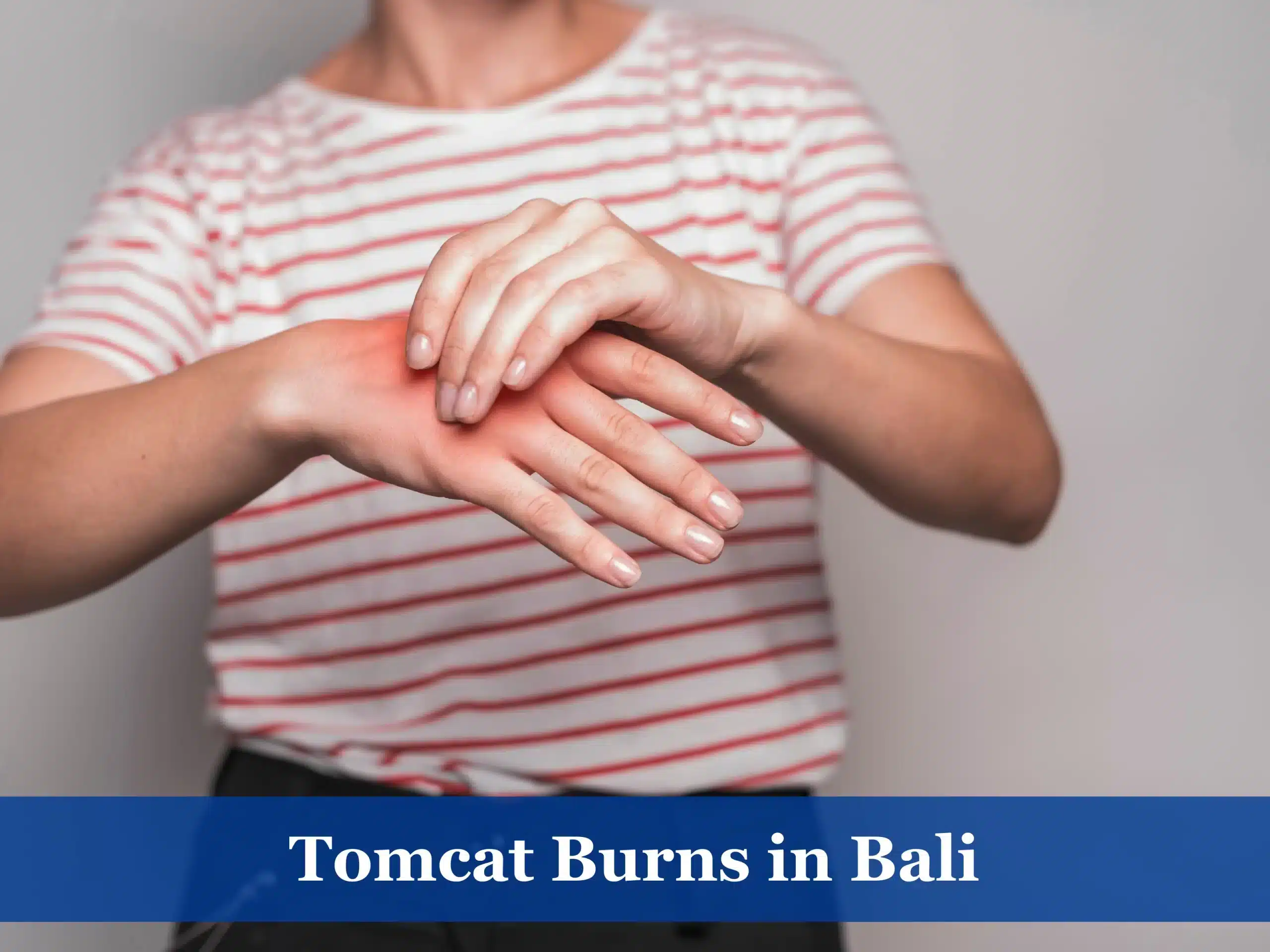 Tomcat burns in Bali
