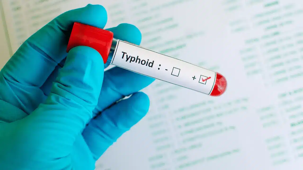 How Typhoid Fever Spreads in Bali
