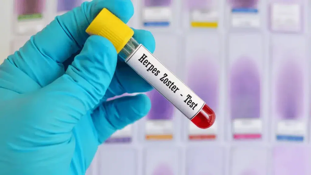 herpes zoster vaccine