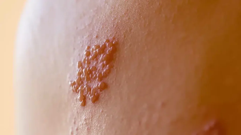 Understanding Herpes Zoster (Shingles)​