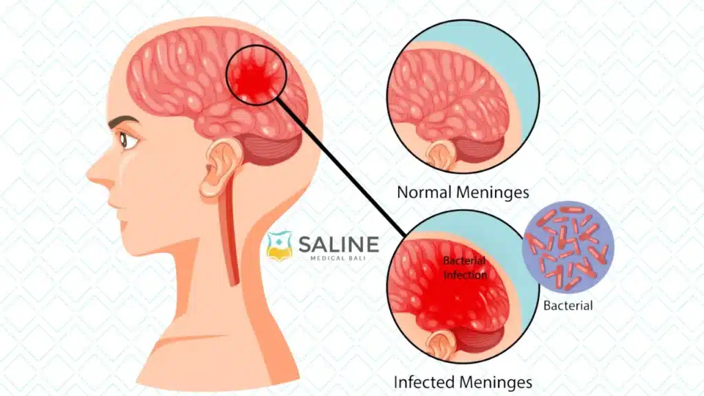 Meningitis Vaccine
